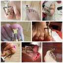 Electroplating Ingrown Toe Nail Correction Tool Toe Paronychia Nail Brace Tool